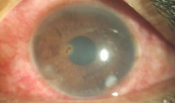 Foreign body ? Cornea ulcer ?