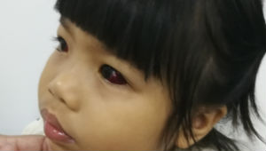 Red Eye ? Hemorrhage?